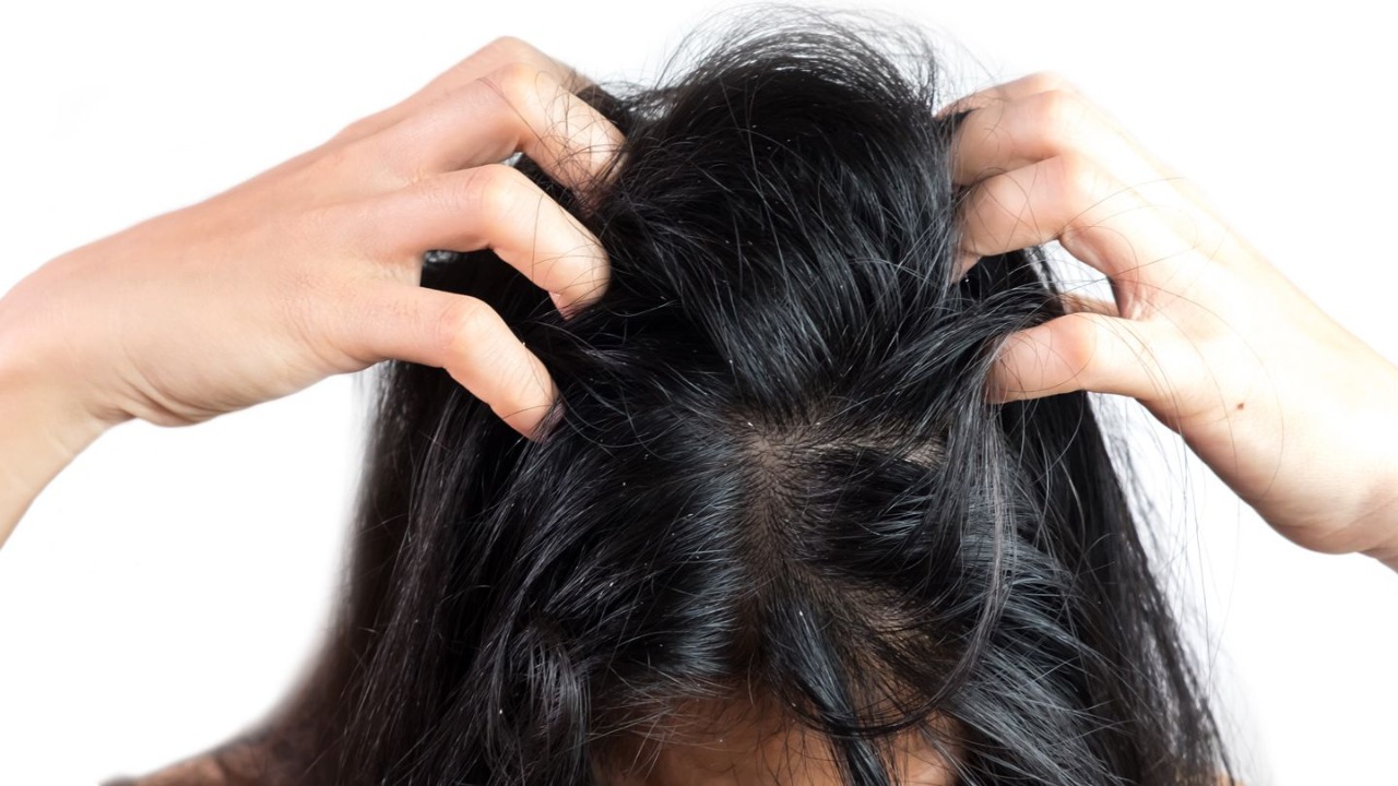 Remedies For Hair Loss